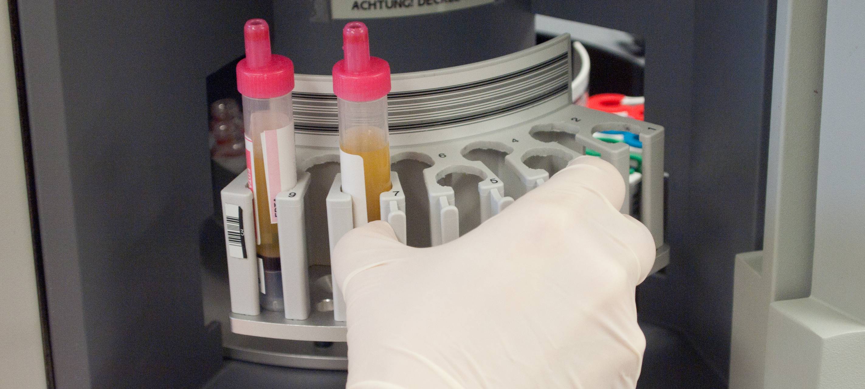 Corona-Fälle in Mönchengladbach