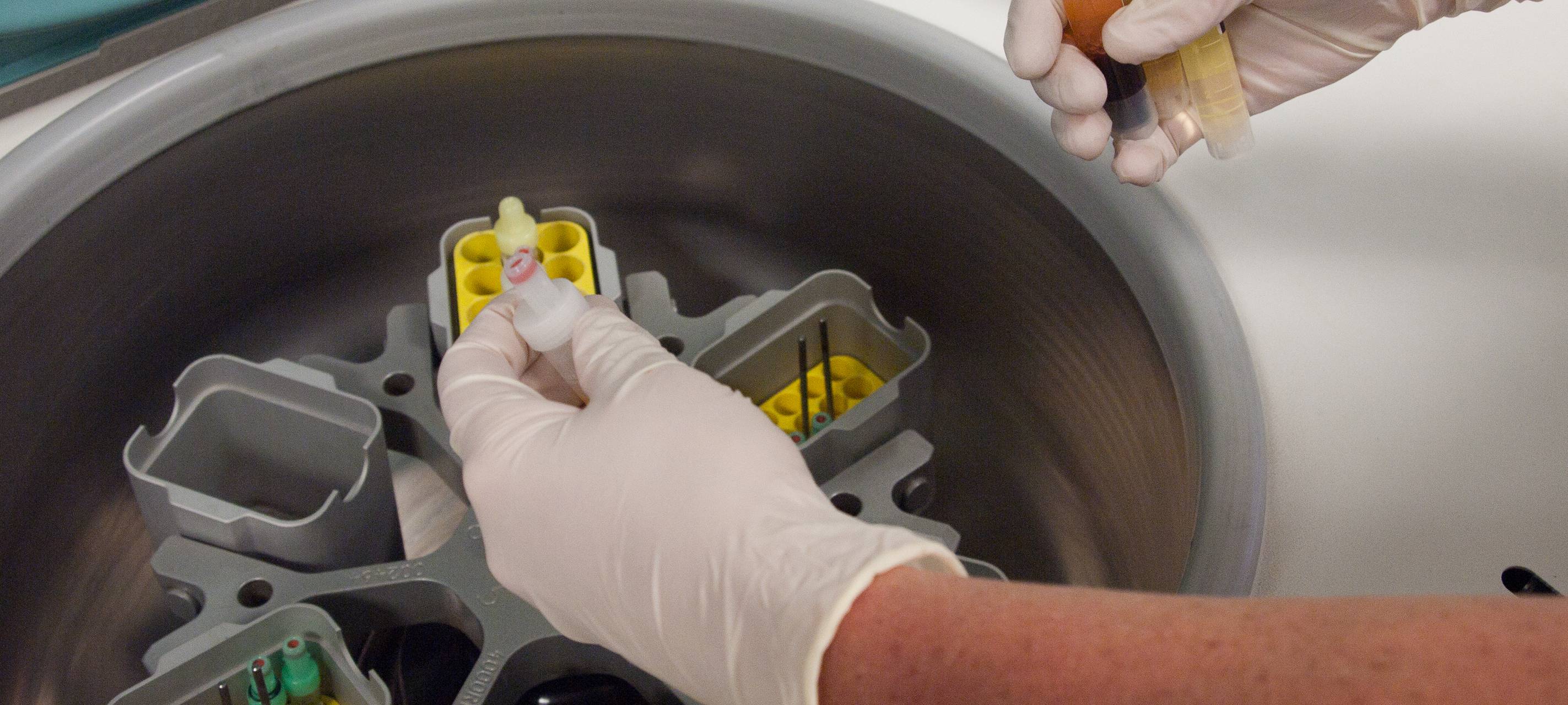 Inzwischen 8 Corona-Infizierte in Mönchengladbach